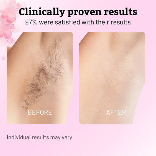 Natural Permanent Hair Remover Oil
