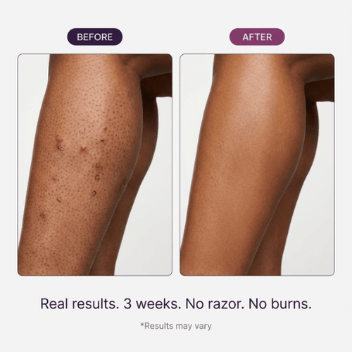 Body Hair Remover